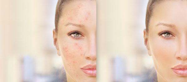Acne Scars + Skin Conditions in Teens and Adults before and after