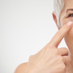Close up of senior woman showing wrinkles before having CO2 Resurfacing