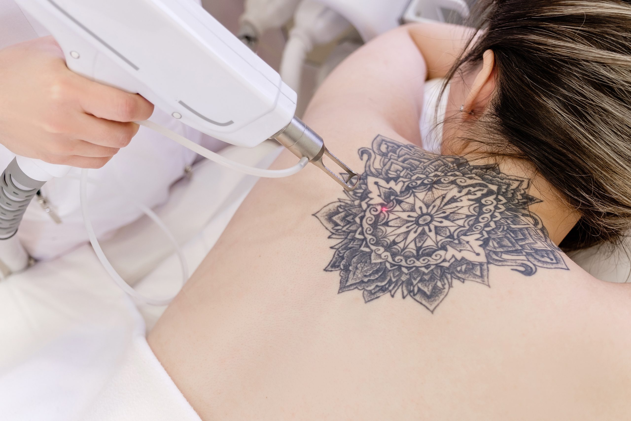 Tattoo Removal Near Me | Tattoo Removal in Tucson, AZ | Medical Spa