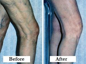 Spider Veins before and after