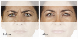 Xeomin Injectables before and after
