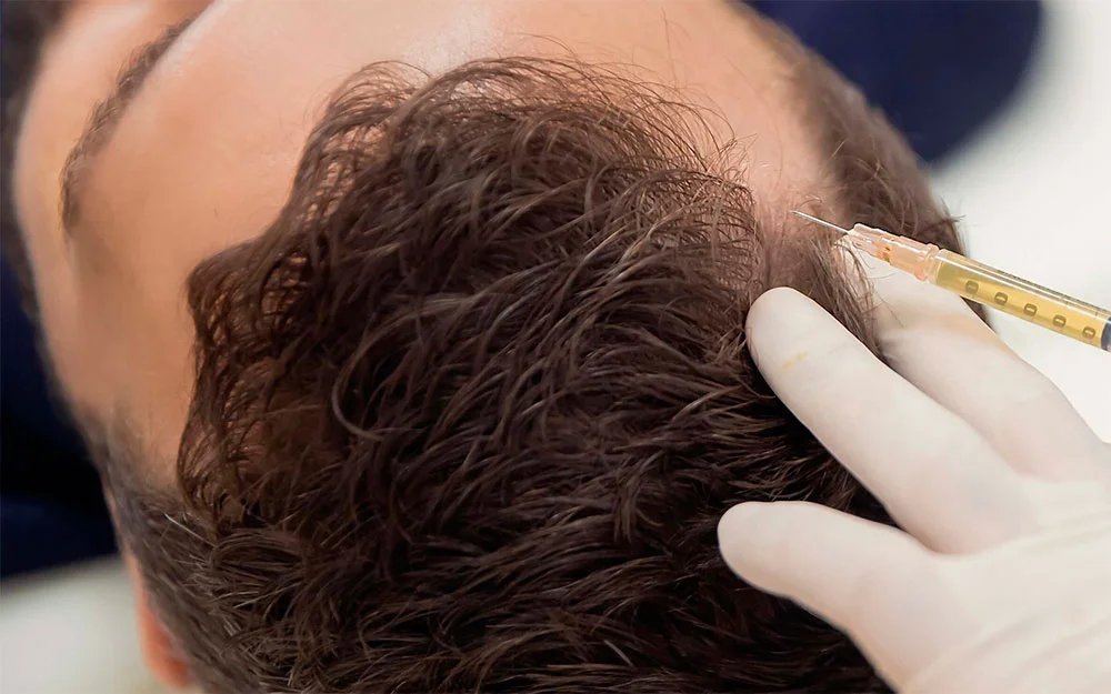 PRP therapy