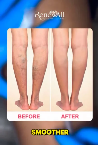 Before and after spider vein removal