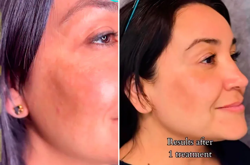 Melasma treatment before and after