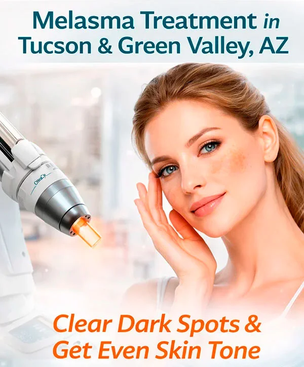 Melasma Treatment in Tucson & Green Valley, AZ