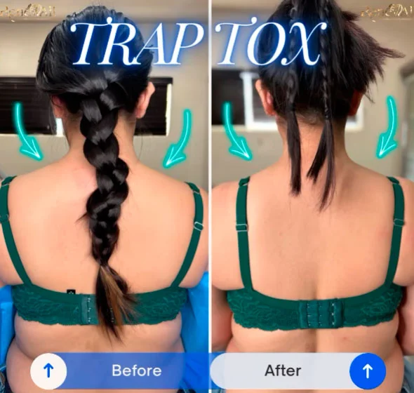 Trap Tox before and after