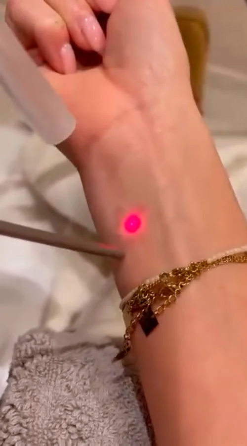 Laser tattoo removal in Tucson, AZ
