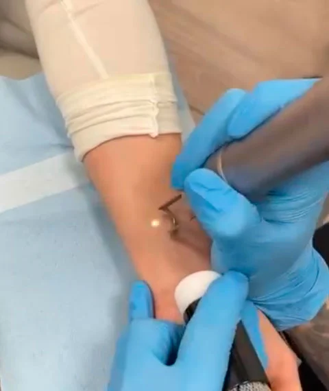 Laser tattoo removal in Tucson, AZ