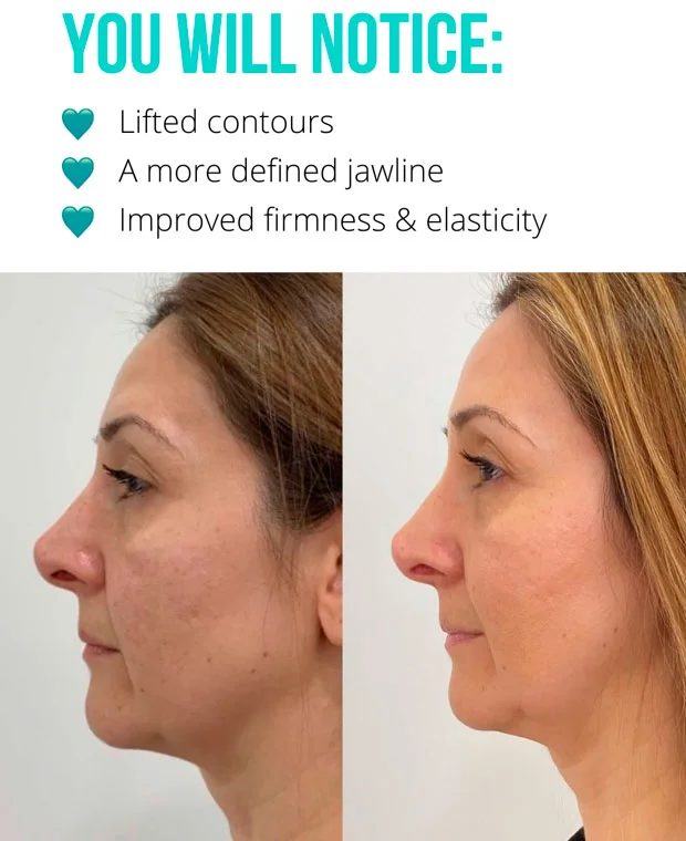 PDO thread lift before and after