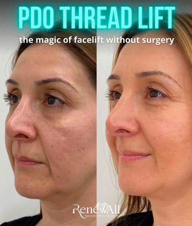 PDO thread lift before and after