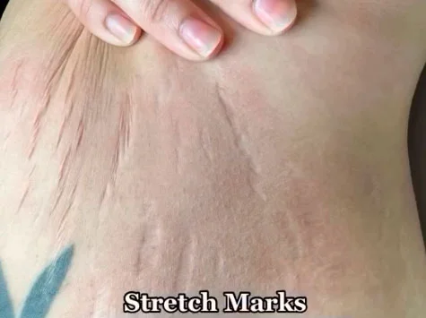 Stretch marks