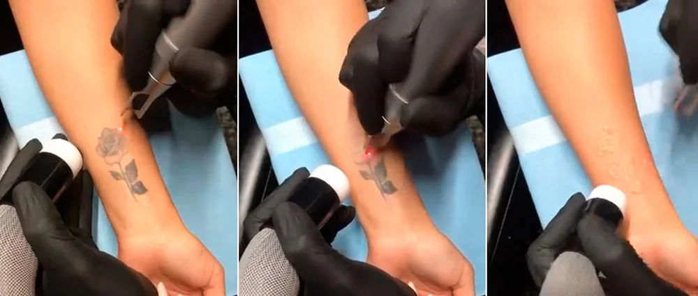 Laser tattoo removal in Tucson, AZ