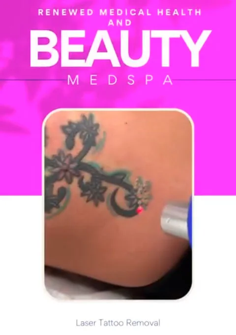 Tattoo removal in Tucson, AZ