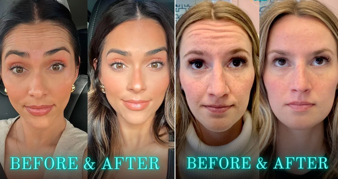 Botox in Tucson and Green Valley, AZ Smooth Wrinkles Safely Botox in Tucson and Green Valley, AZ Smooth Wrinkles Safely