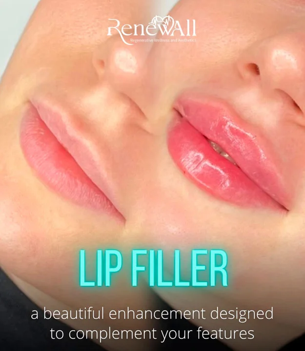 Lip filler before and after