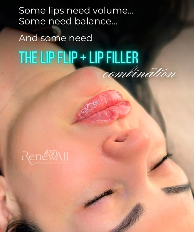 Lip filler
