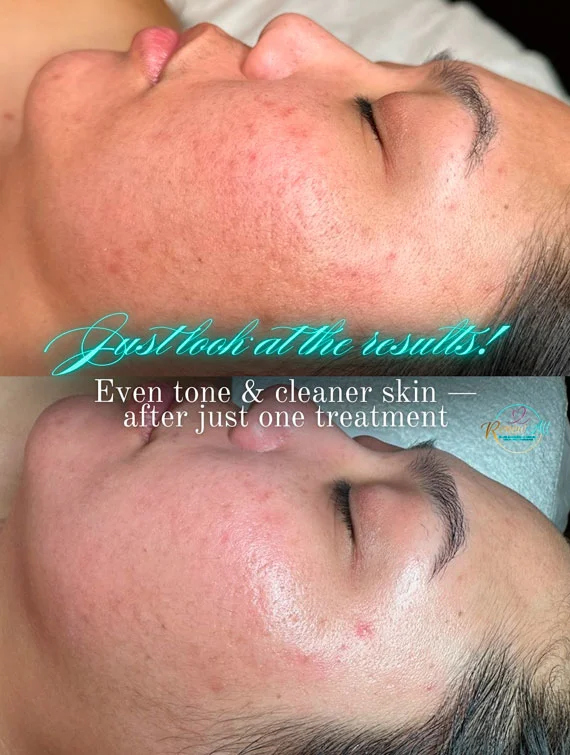 DiamondGlow facials before and after