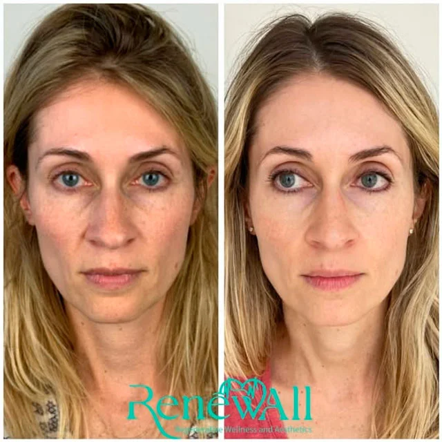 Sculptra before and after