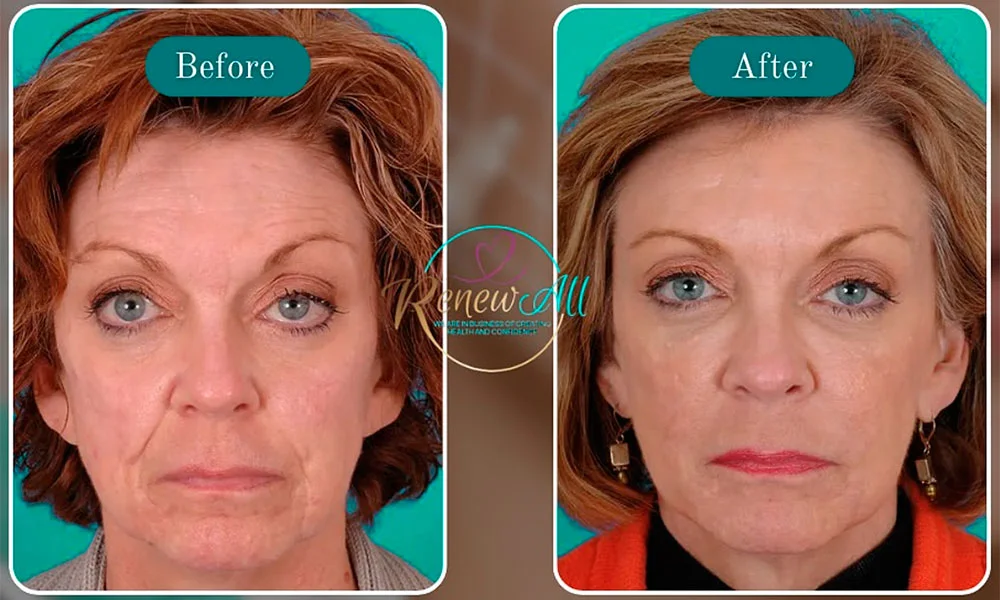 Sculptra before and after