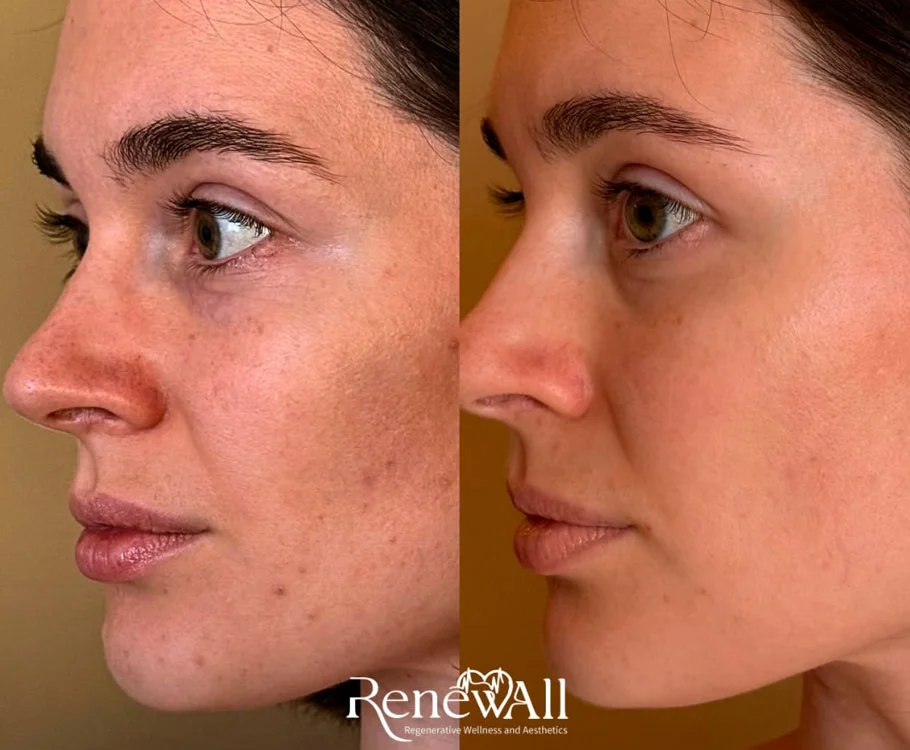 Red light therapy before and after