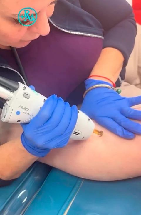 Laser spider vein removal in Tucson, AZ