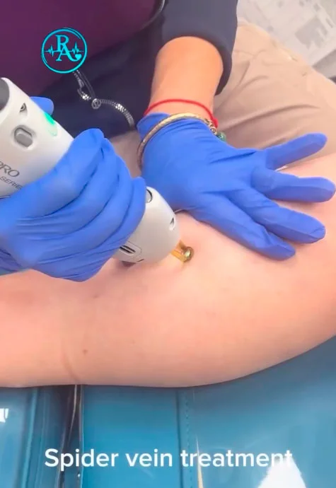 Laser spider vein treatment in Tucson, AZ