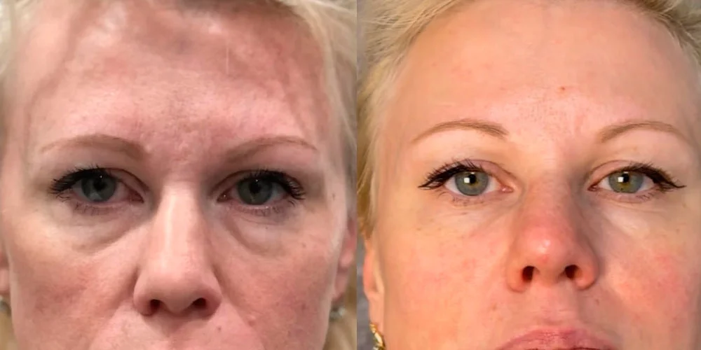 Under eye bags treatment before and after