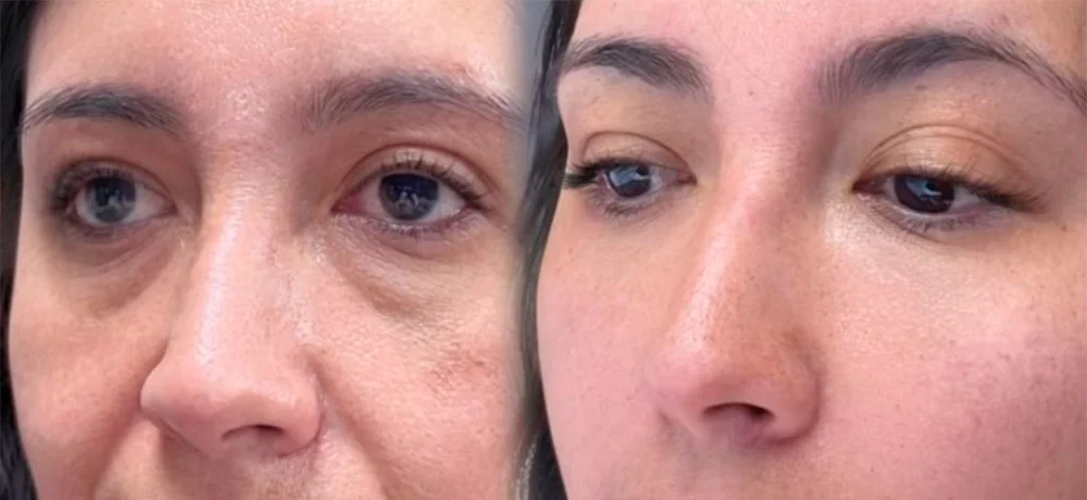 Under eye bags treatment before and after
