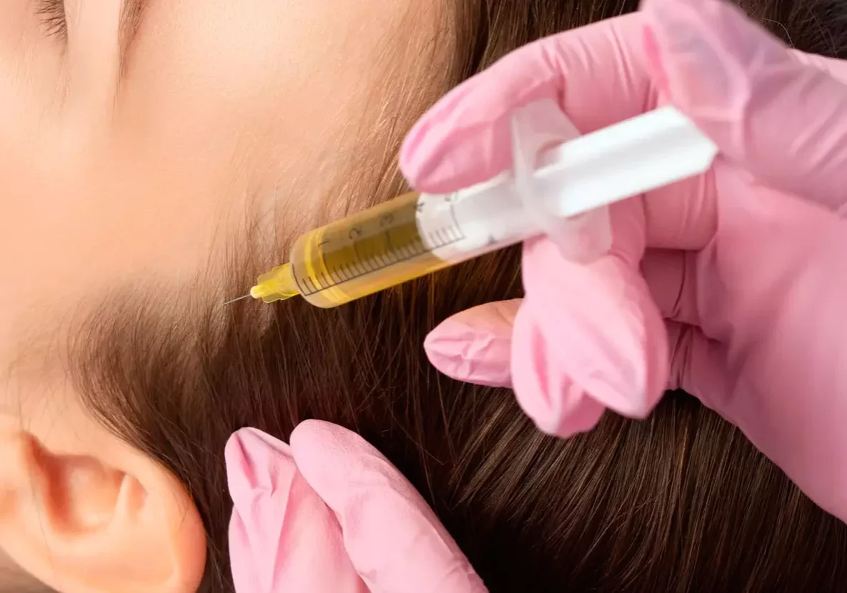 PRP therapy
