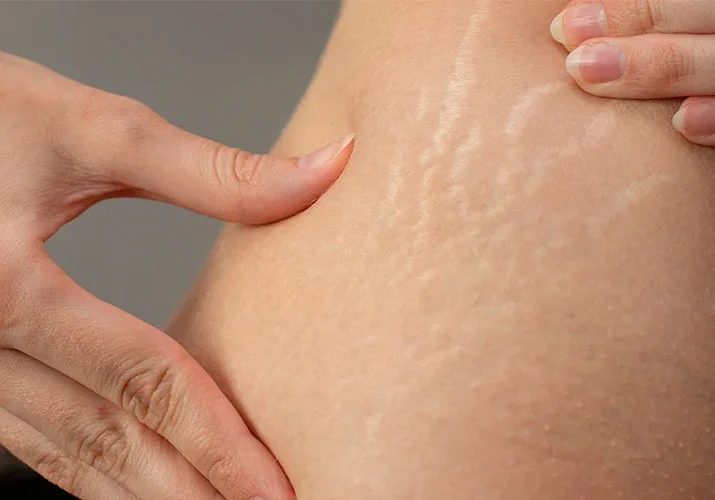 Stretch marks